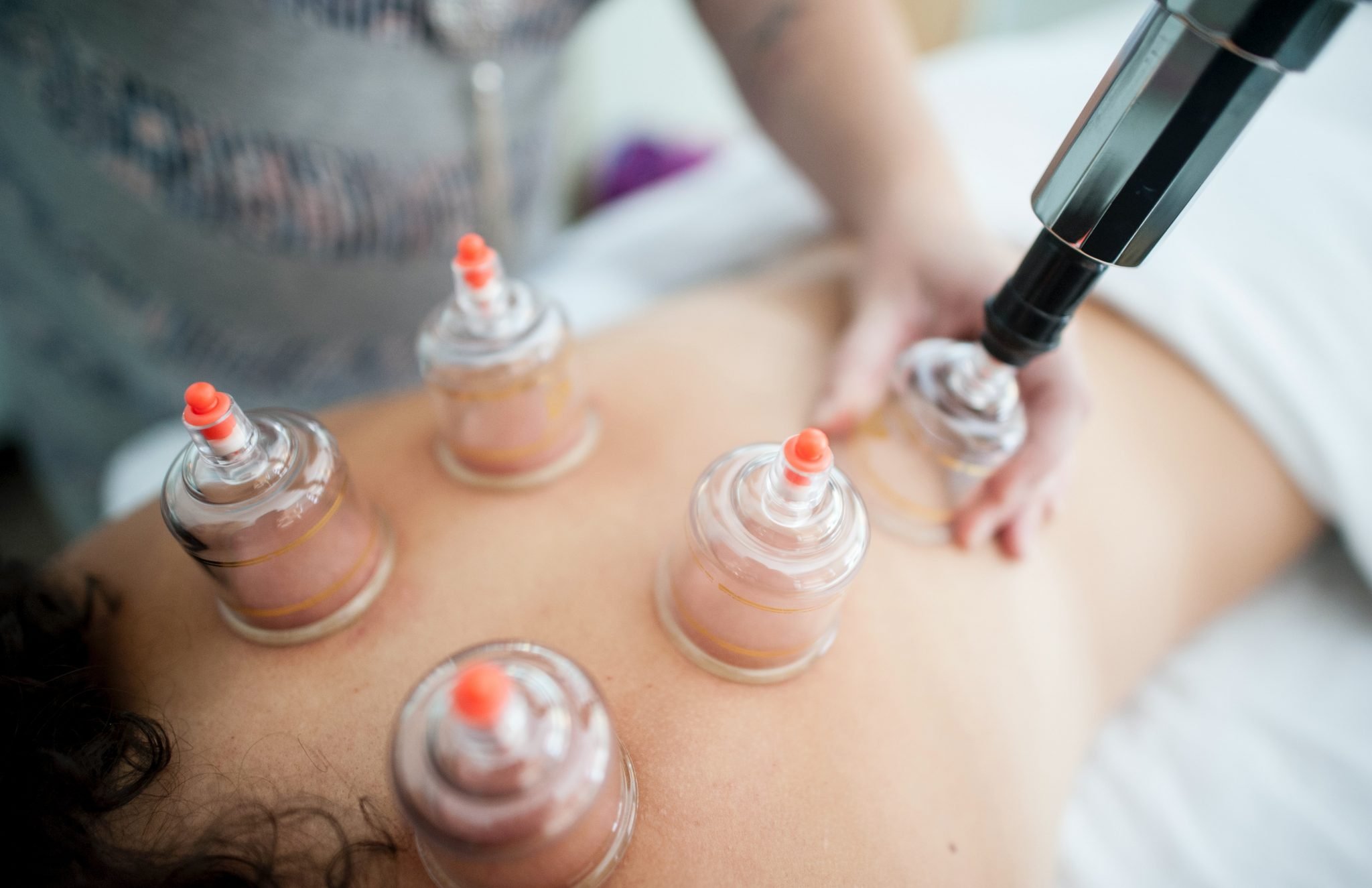 dry cupping treatment showing cups on clients back